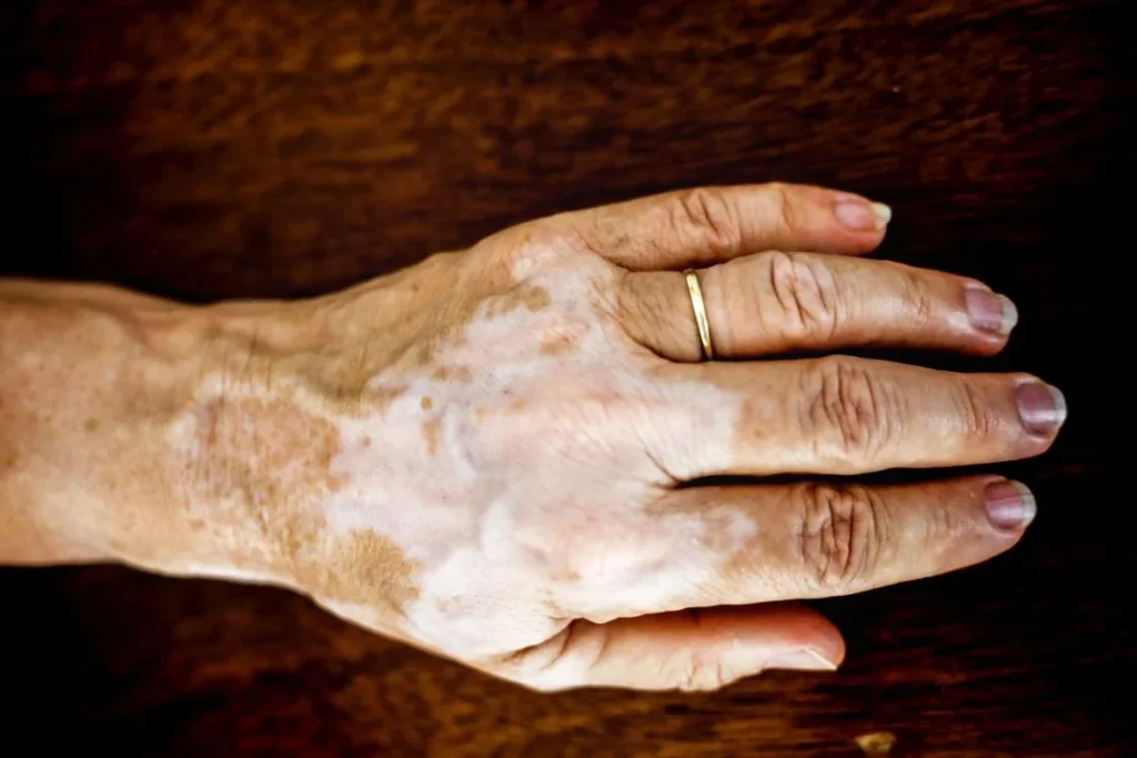 vitiligo on white brown hand 6