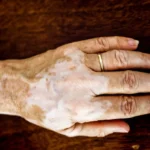 vitiligo on white brown hand 20