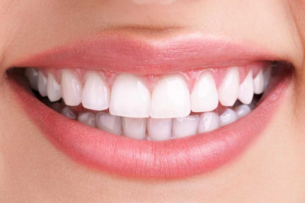 teeth whitening after treatment 4