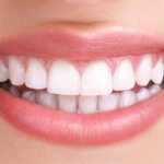 teeth whitening after treatment 17